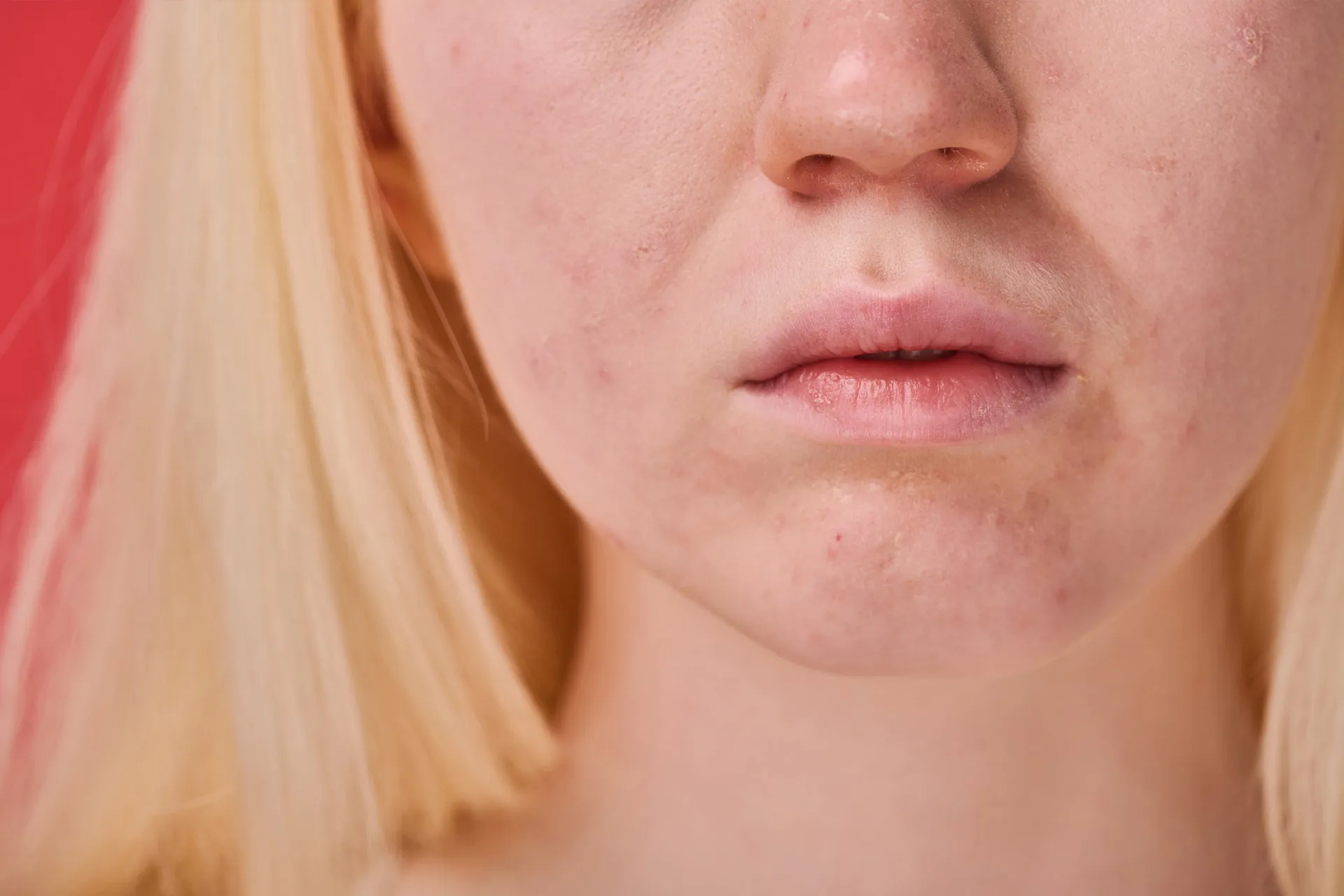 Hautunreinheiten und verstopfte Poren im Gesichtsbereich